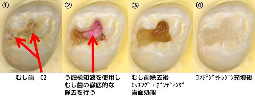 保険診療での詰め物治療について ②コンポジットレジン治療 | 町田の